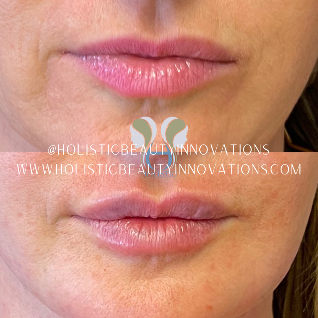 Before and After - Holistic Beauty Innovations, LLC | Scottsdale, AZ