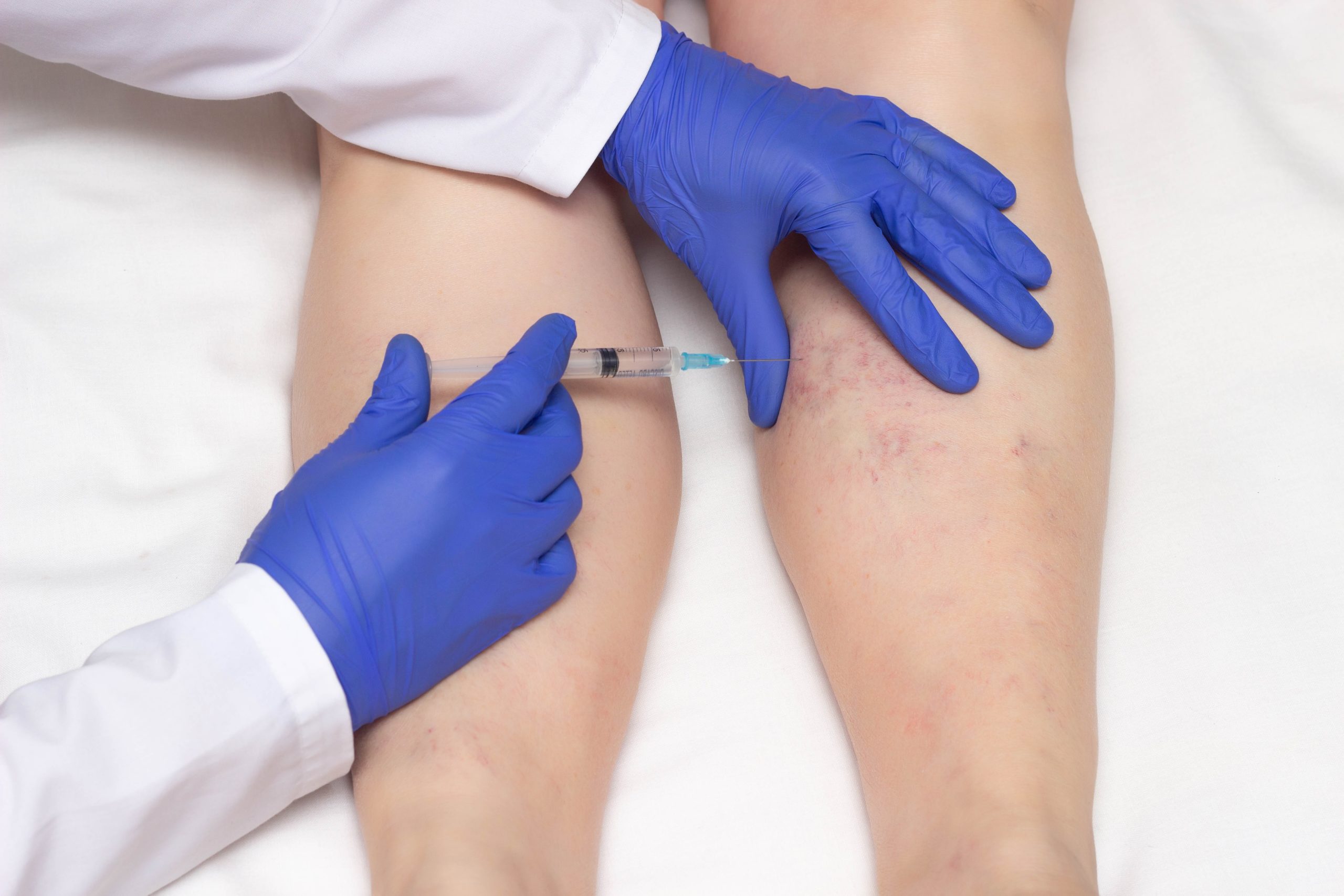 Sclerotherapy: What does it Treat, Cost, Aftercare, and Expected Results