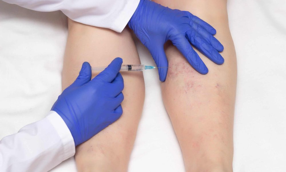 Sclerotherapy: What does it Treat, Cost, Aftercare, and Expected Results